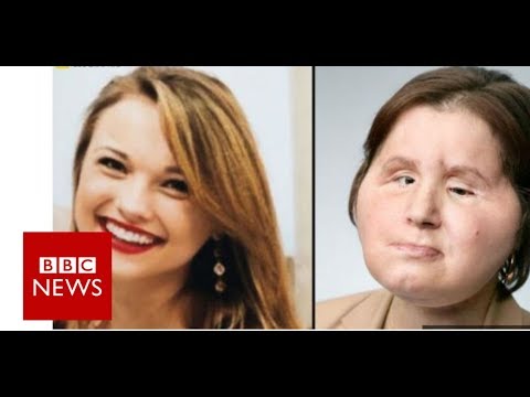 Coping with our daughter’s new face – BBC News